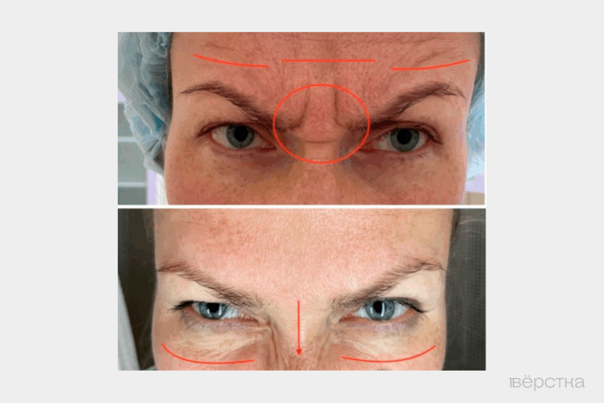 Компенсаторные морщины после инъекции ботокса