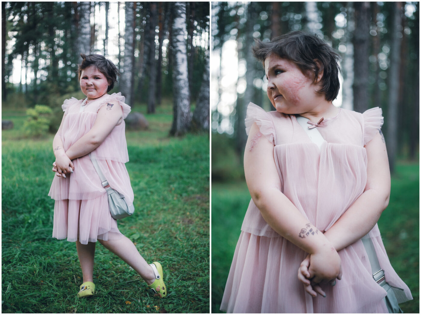 В&nbsp;Ярославской области работает единственный в&nbsp;России лагерь для детей с&nbsp;ожогами. Его организовал фонд «Детская больница» при больнице имени Сперанского